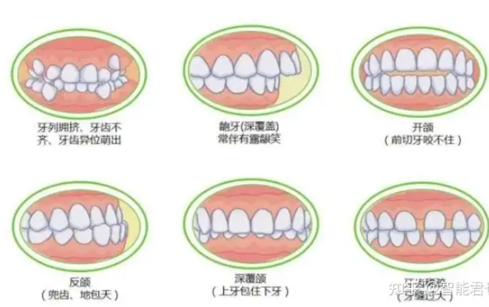 不要让口呼吸毁了你?(大概率是鼻炎惹的祸) image-1.png