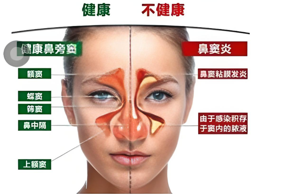 从鼻窦炎的折磨到重拾生活(鼻窦炎怎么办) image-10.png