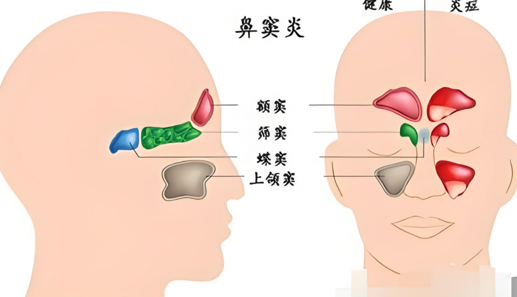 我是怎么应对鼻窦炎的 image-20-1024x590.png