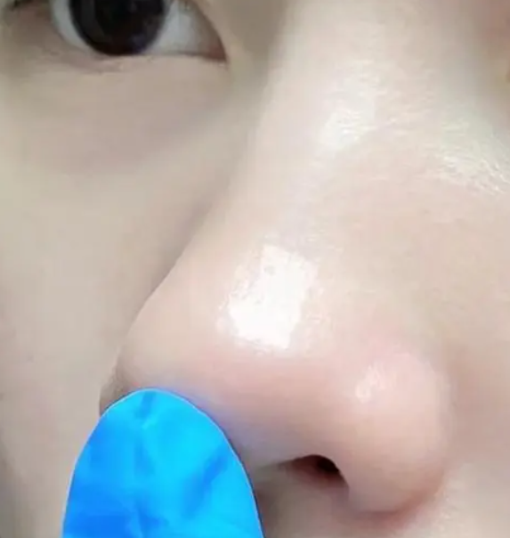 20年老鼻炎都是怎么过的 image-25.png