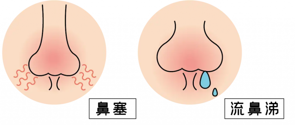 鼻炎是小事吗 image-29-1024x433.png