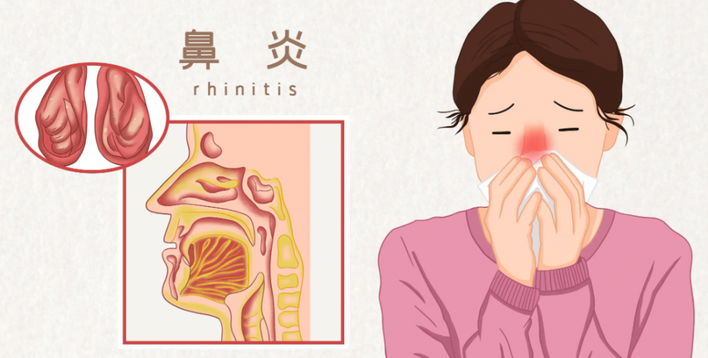 鼻炎为什么不能拖? image-6-1024x518.png