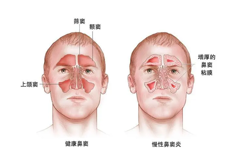 鼻窦炎能自己恢复吗? image-7.png