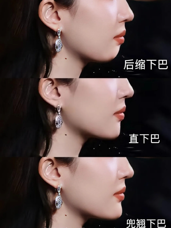 不要让口呼吸毁了你?(大概率是鼻炎惹的祸) image.png